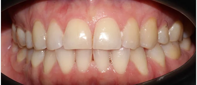 Ортодонтическое лечение на элайнерах №4