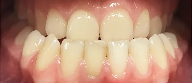 Исправление мезиального прикуса с помощью элайнеров Invisalign и минивинтов