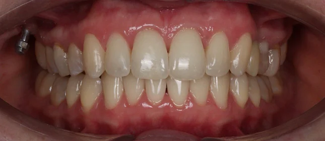 Лечение аномалии соотношения зубных дуг элайнерами