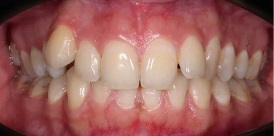 Ортодонтическое лечение на брекет-системе