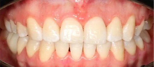 Ортодонтическое лечение на брекет-системе №1