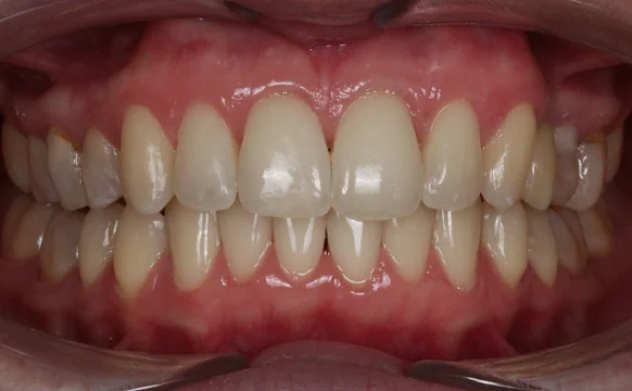 Лечение аномалии соотношения зубных дуг элайнерами