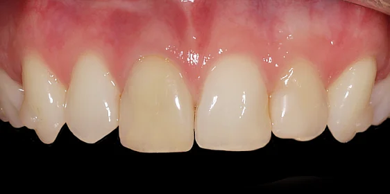 Улучшение эстетики верхних зубов после ортодонтического лечения