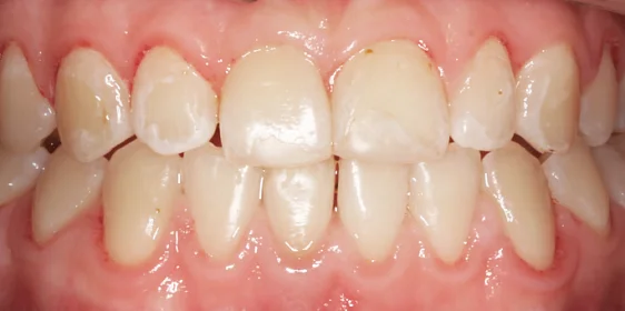 Исправление мезиального прикуса с помощью элайнеров Invisalign и минивинтов