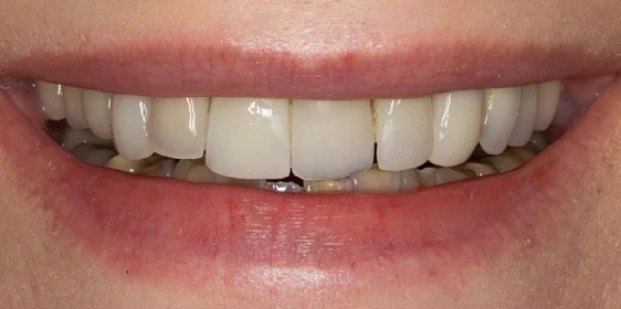 Установка виниров