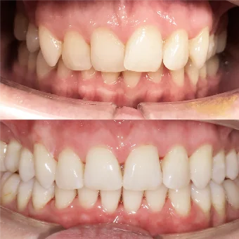 Исправление глубокого перекрытия зубов без брекетов