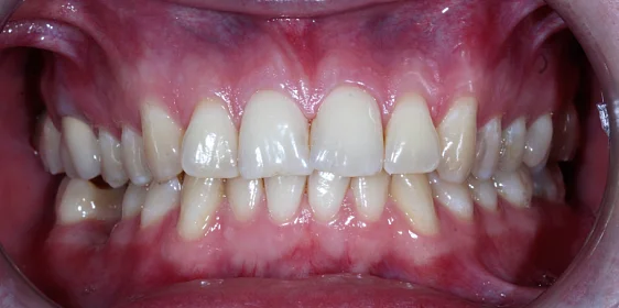 Лечение аномалии соотношений зубных дуг на брекет-системе