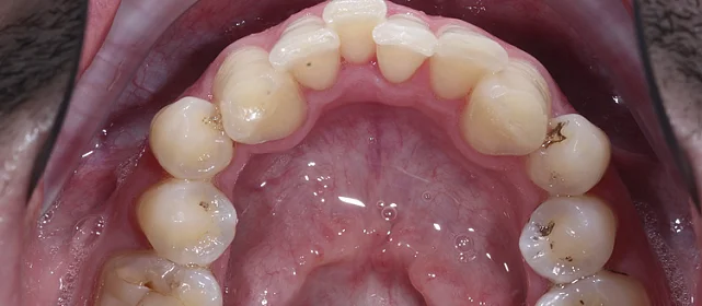 Исправление сужения ВЗР и НЗР элайнерами Invisalign