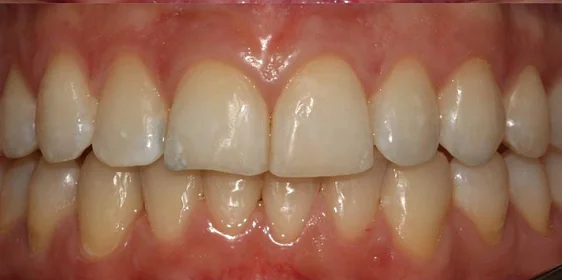 Ортодонтическое лечение на элайнерах