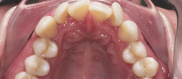 Расширение элайнерами