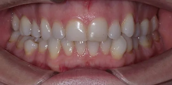 Лечение неправильного прикуса элайнерами