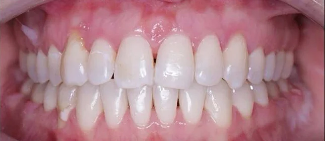 Лечение прикуса на брекет-системе