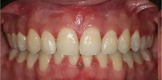 Ортодонтическое лечение на брекет-системе