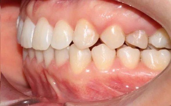 Ортодонтическое лечение на системе Click