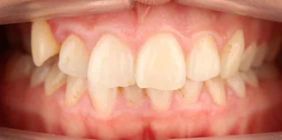 Ортодонтическое лечение нa брекет-системе