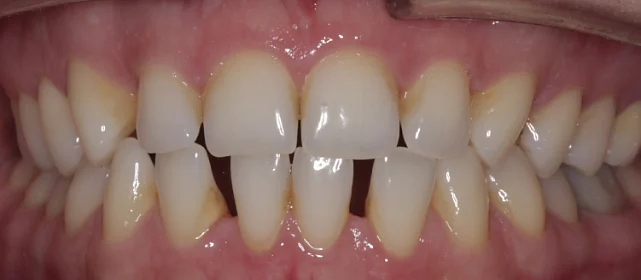 Закрытие промежутков между зубами с последующем установлением виниров