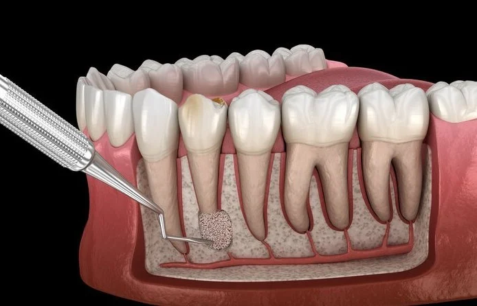 периостит челюсти фото