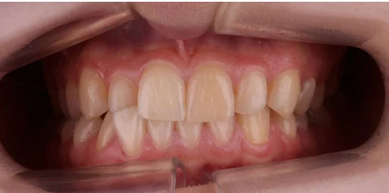 Ортодонтическое лечение на системе Click