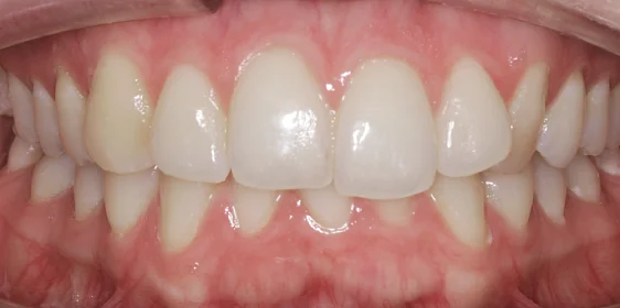 Расширение и выравнивание верхнего и нижнего зубных рядов