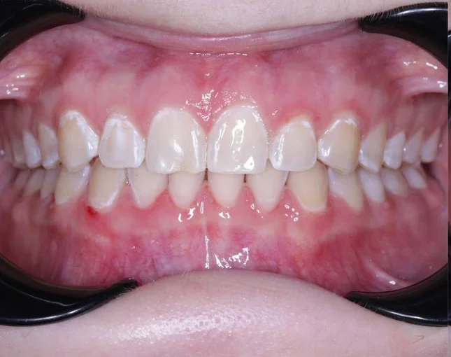 Лечение диастемы на верхней челюсти на элайнерах Click