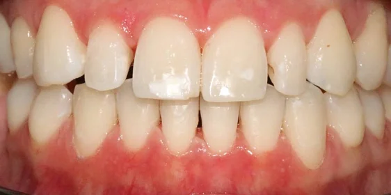 Коррекция аномалии положения зубов на элайнерах