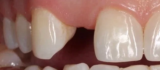 Имплантация Straumann