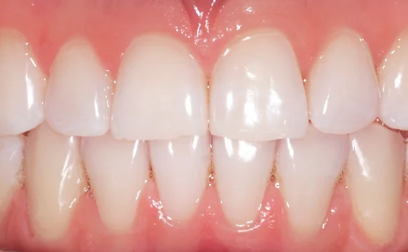 Исправление прикуса элайнерами Инвизилайн