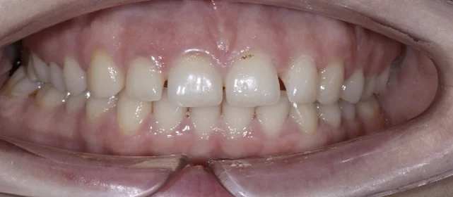 Закрытие промежутков между зубами