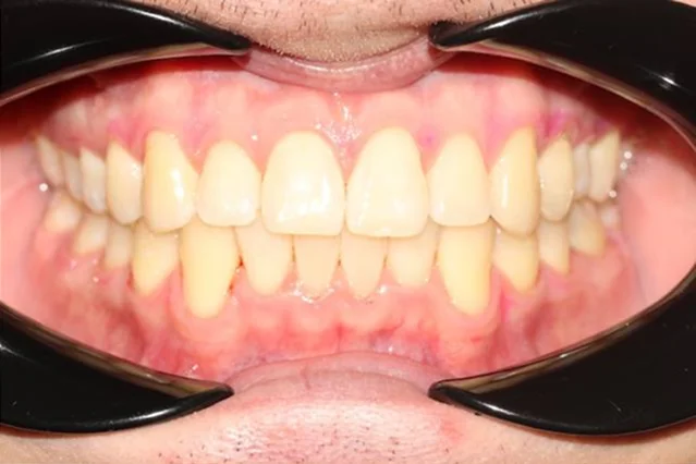 Ортодонтическое лечение на элайнерах