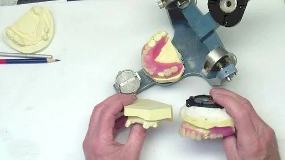 изготовление иммедиат протеза фото