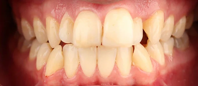 Ортодонтическое лечение на брекет-системе