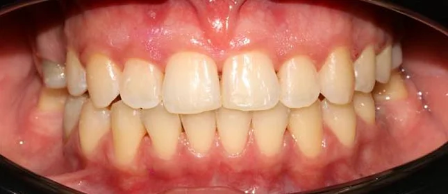 Лечение аномалии соотношений зубных дуг на элайнерах