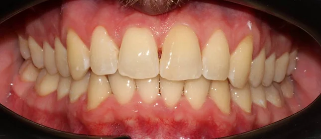 Ортодонтическое лечение на системе Click №3