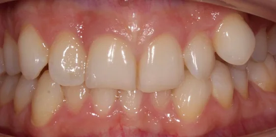 Ортодонтическое лечение на элайнерах