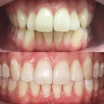 Исправление фронтальной группы зубов капами Инвизилайн