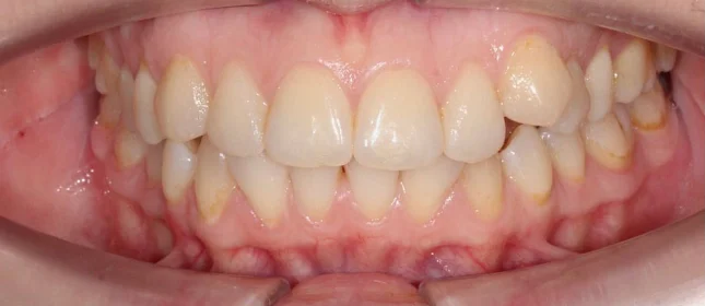 Лечение скученности зубов элайнерами