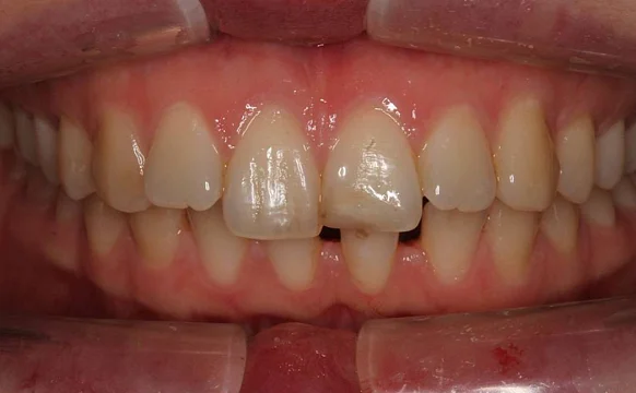 Лечение дистальной окклюзии на брекет-системе