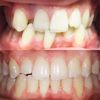 Завершающий этап лечения скученности и обратного перекрытия