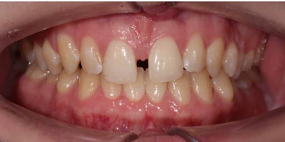 Ортодонтическое лечение на элайнерах