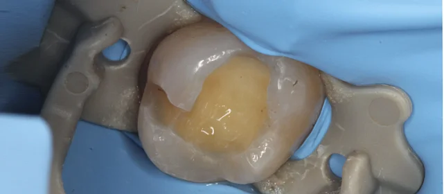 Эстетическая реставрация зубов