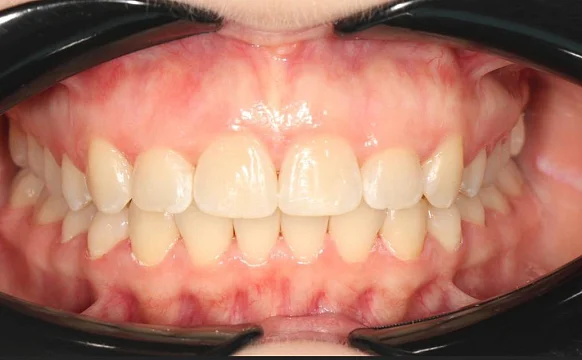 Лечение cкученности на нижней челюсти на элайнерах