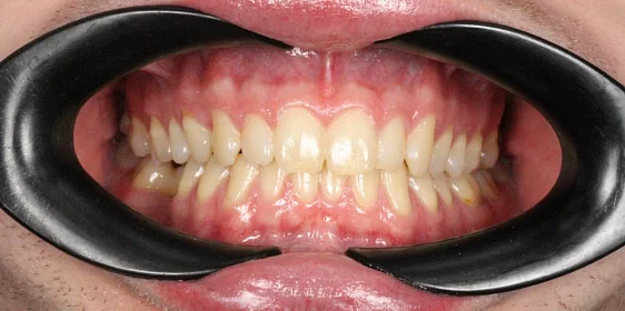 Ортодонтическое лечение на системе Click