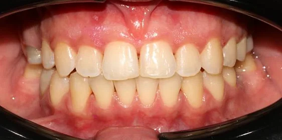 Лечение аномалии соотношений зубных дуг на элайнерах