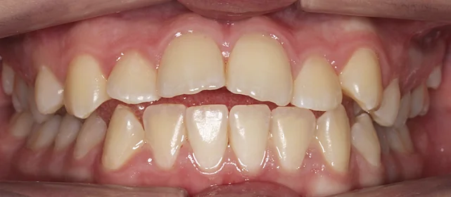 Исправление открытого прикуса у подростка