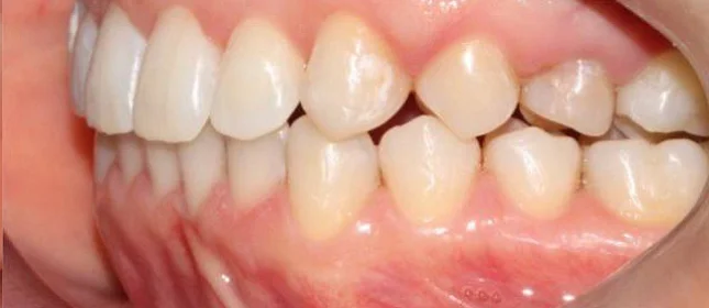 Ортодонтическое лечение на системе Click №1