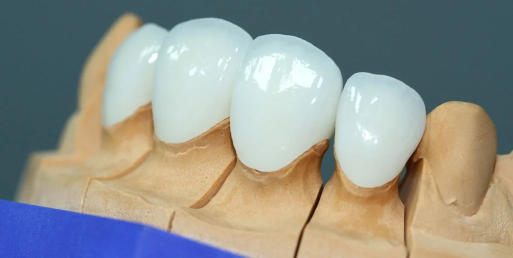 коронки и виниры