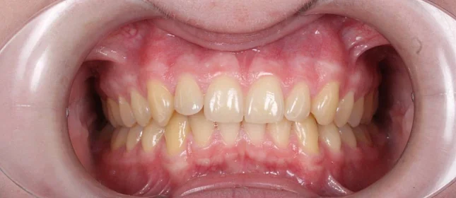 Ортодонтическое лечение на брекет-системе №4