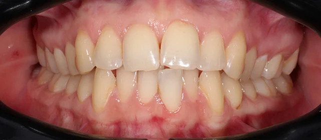 Скученность, протрузия на верхней и нижней челюсти