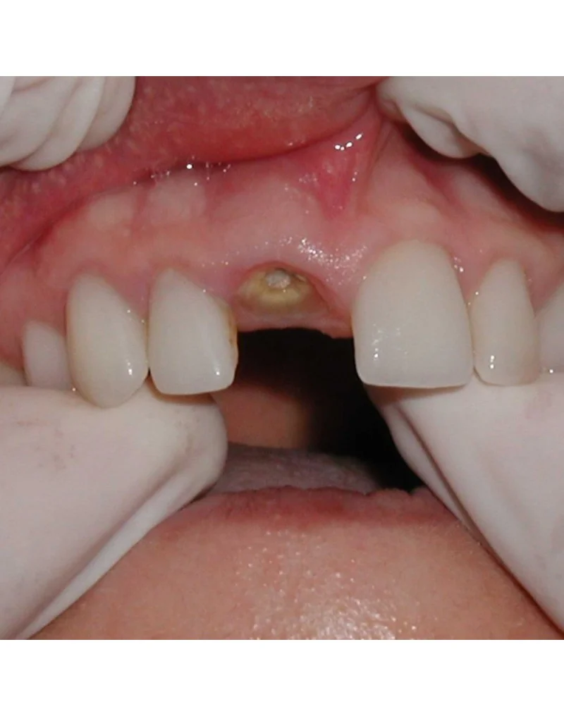 периостит у детей фото