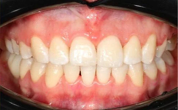 Ортодонтическое лечение на брекет-системе